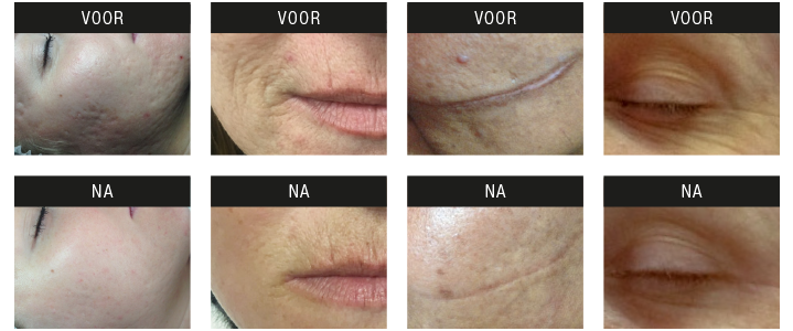 Dermapen resultaten